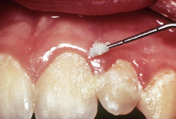 100% preventable: dental caries and other oral diseases